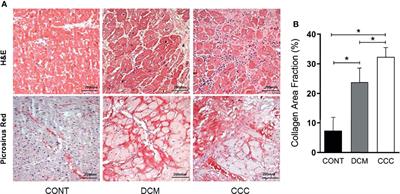 Matrix Metalloproteinase 2 and 9 Enzymatic Activities are Selectively Increased in the Myocardium of Chronic Chagas Disease Cardiomyopathy Patients: Role of TIMPs